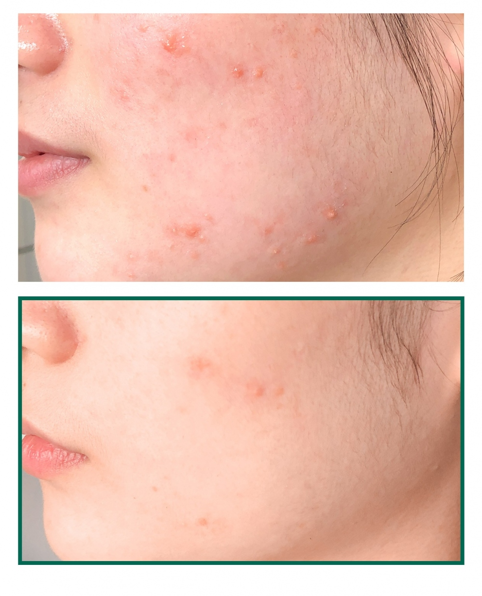 Some By Mi Mousse anti-acné miracle 30 jours AHA BHA PHA Korean Beauty & Healthy LTDKorean skincare Glow up
